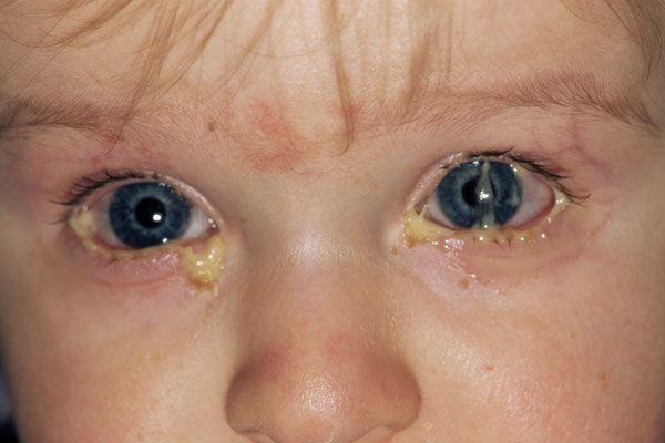 øyekatarr øyekatarr