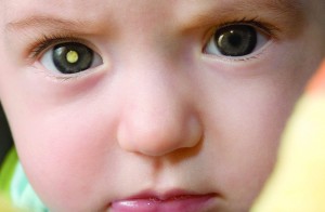 retinoblastoma retinoblastoma